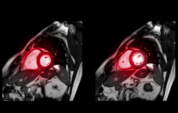MIR images of heart, courtesy Getty Images.