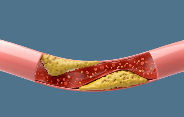 Illustration of partially clogged artery, courtesy Getty Images.