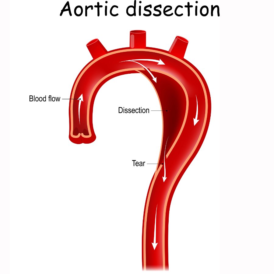 Biobank facilitates research into genetic markers for aortic dissection