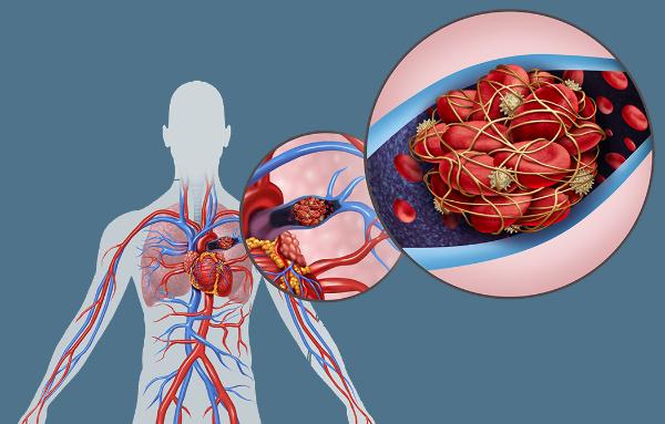 Illustration of cardiovascular system with blowup of diseased artery, courtesy Getty Images.