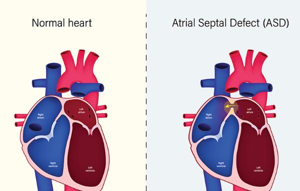 Illustrations of a normal heart and a heart with an atrial septal defect. Courtesy Getty Images.