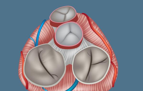 Illustration of diseased cardiac valves, courtesy Getty Images.
